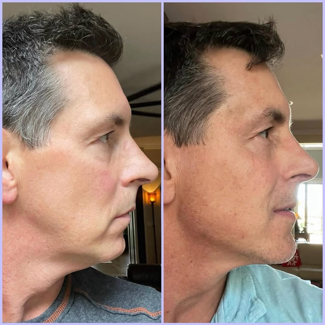 Instagram post by Dr. Randy Lindgren: Nonsurgical Face & Neck Lift This patient traveled to us with concerns of some laxity in his face and neck that had developed. We used derma…