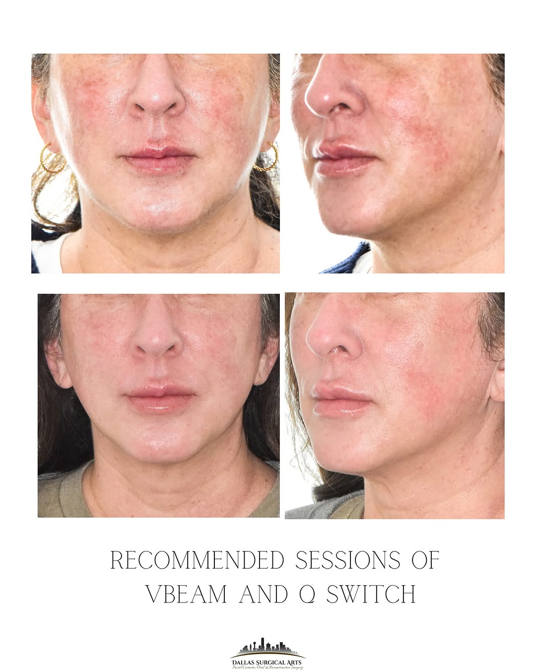 Instagram post by Dr. Randy Sanovich: Why target one concern when you can target two?⁠ VBeam for redness, Q-switched for stubborn pigment. Two lasers, two targets, one customized…