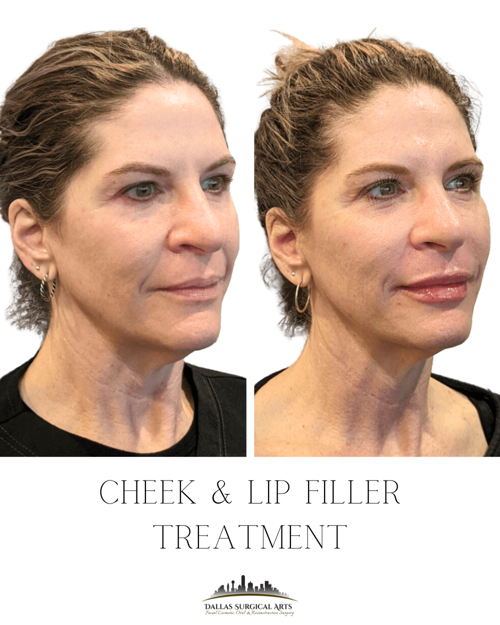 Instagram post by Dr. Randy Sanovich: Enhancing what’s already beautiful✨ ⁠ A touch of lip and cheek filler for soft, natural-looking results.⁠ ⁠ ⁠ ⁠ ⁠ ⁠ #dallassurgicalarts #fil…