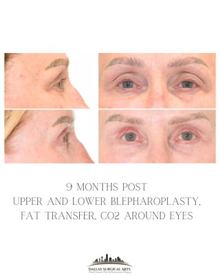 Instagram post by Dr. Randy Sanovich: Blepharoplasty fixes the structure. CO₂ laser helps upgrade the skin. 😉✨⁠ ⁠ It’s the ultimate “while we’re here…” combo.⁠ ⁠ Pairing blephar…