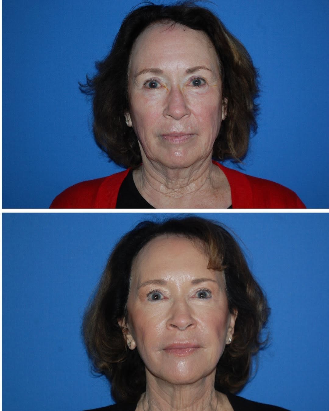 Instagram post by Dr. Randy Tate: This patient came to us for an overall consultation for aging. Dr. Tate performed a laser, an upper and lower blepharoplasty and a mini face…