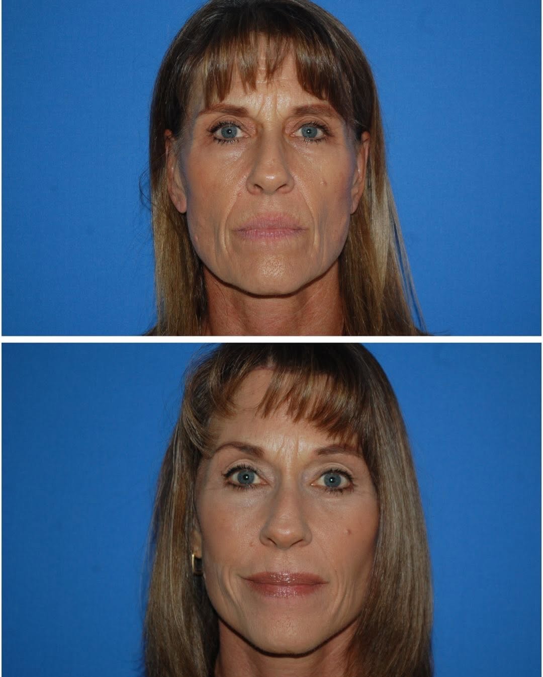 Instagram post by Dr. Randy Tate: This is a perfect example of how great you can look two months exactly after surgery. This patient had a mini facelift, brow lift, bilateral…