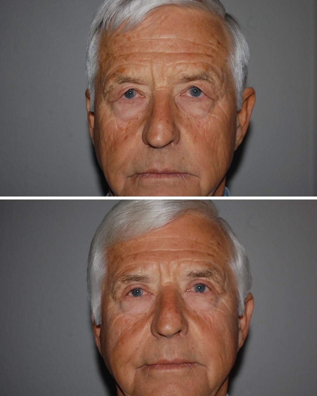 Instagram post by Dr. Randy Tate: This patient had a bilateral upper blepharoplasty. An absolute office favorite! Such a sweet patient with an amazing result. #thefacialexper…
