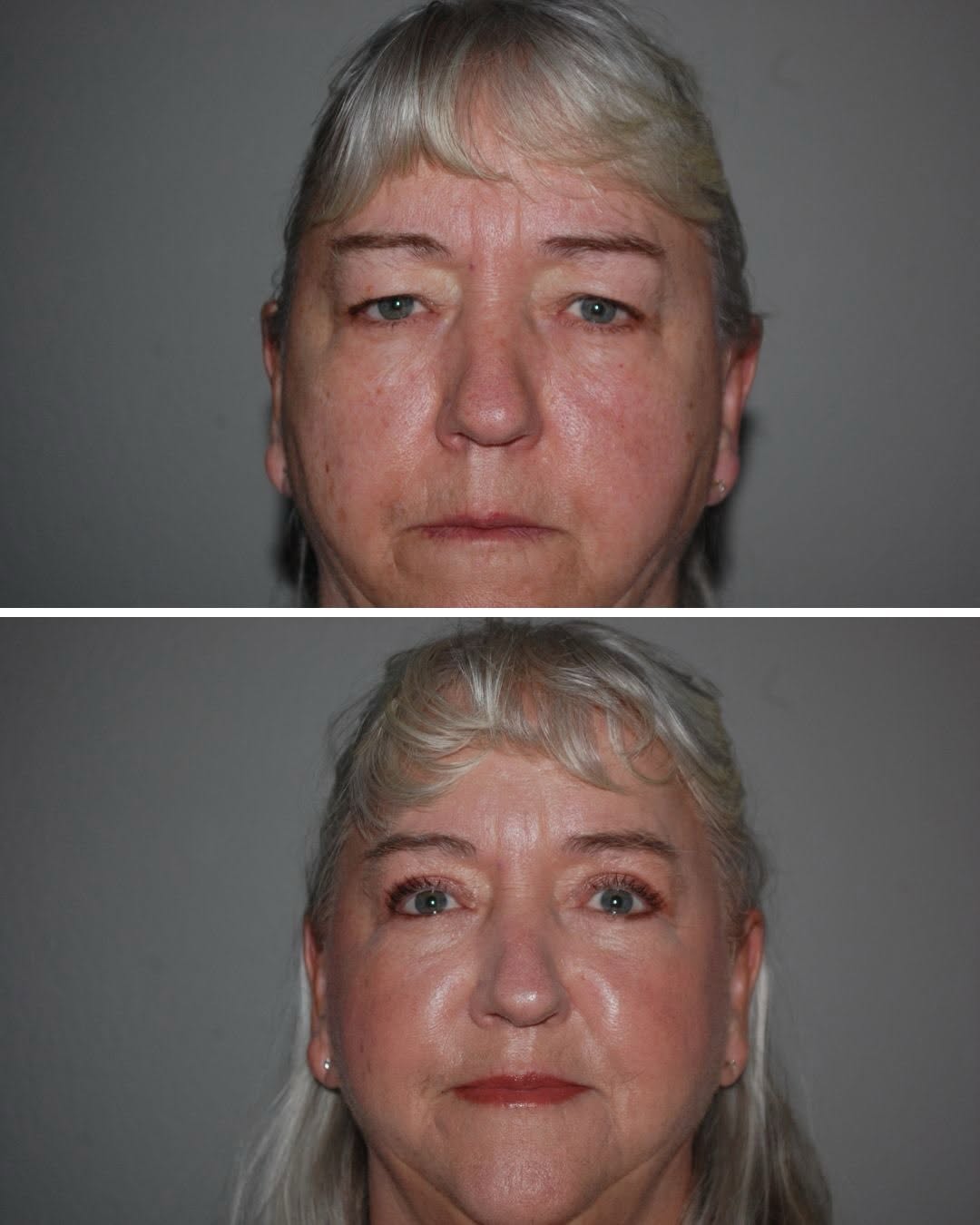 Instagram post by Dr. Randy Tate: Another amazing result of a bilateral upper blepharoplasty by Dr. Randy Tate. #thefacialexperts #drrandytate #reddingplasticsurgeon #doubleb…