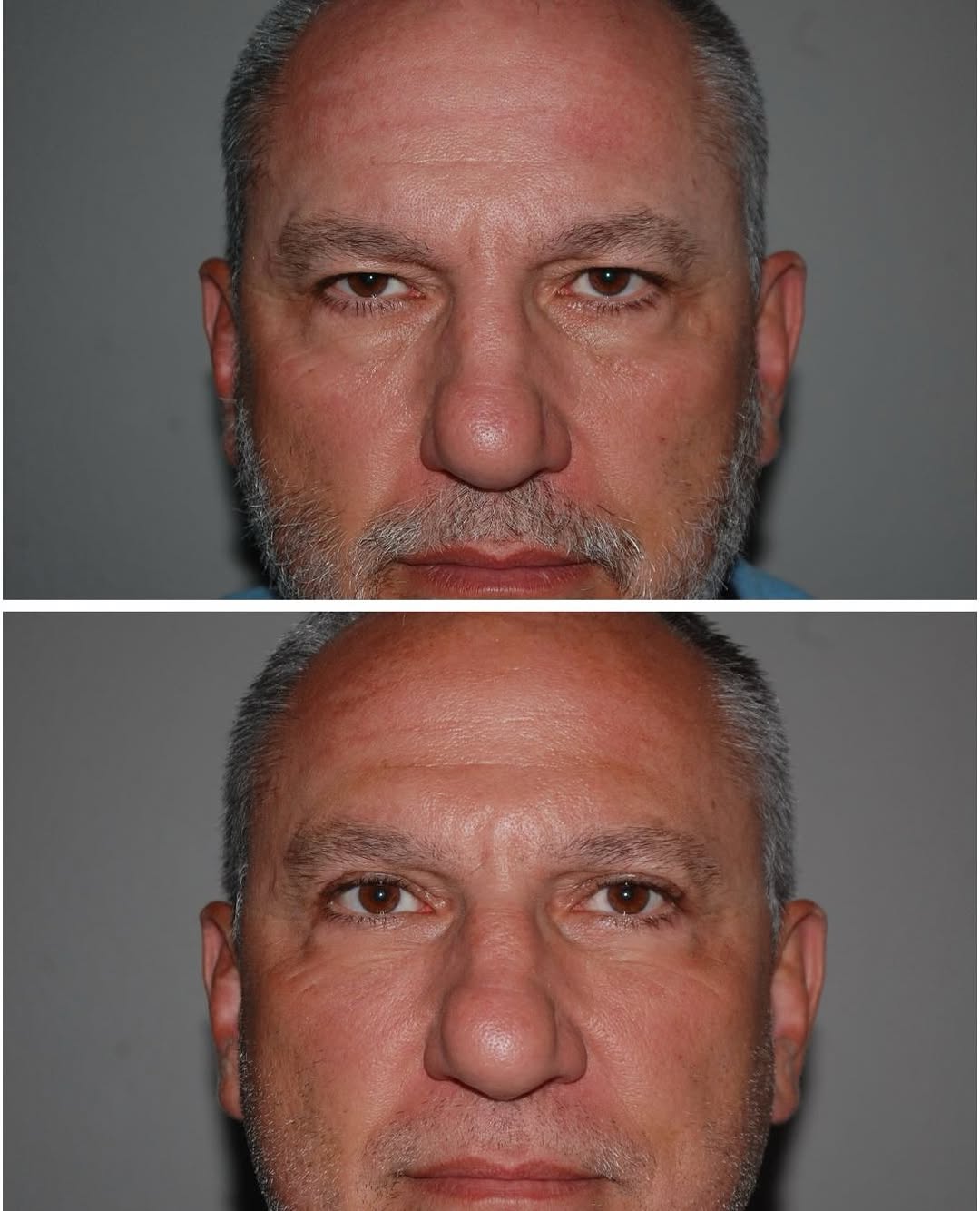 Instagram post by Dr. Randy Tate: Before and after of a bilateral upper blepharoplasty on a 54 year old man. This is a great way to show how a small procedure can make a huge…