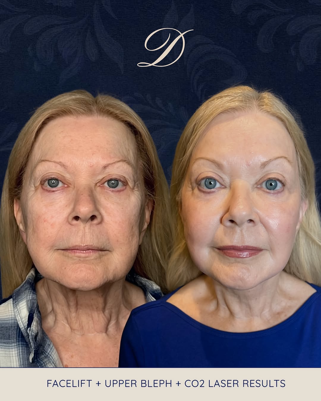Instagram post by Dr. Ravi Dahiya: This patient came in ready for a refreshed, more youthful appearance, and her treatment plan was designed to address both facial structure A…