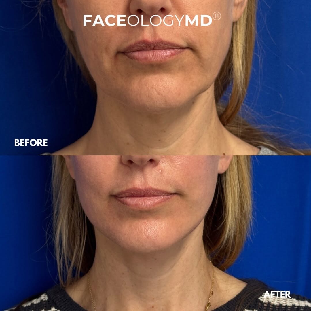 Instagram post by Dr. Raymond E. Lee: She didn't want to look different. She wanted to look like herself again. 30 days post-op, and that's exactly what's happening... the jawlin…