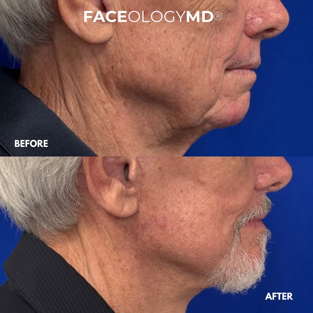 Instagram post by Dr. Raymond E. Lee: Before & after a Deep Preservation Facelift by @dr.raymondlee @faceologymd The goal isn’t to change who you are it’s to restore a naturally …