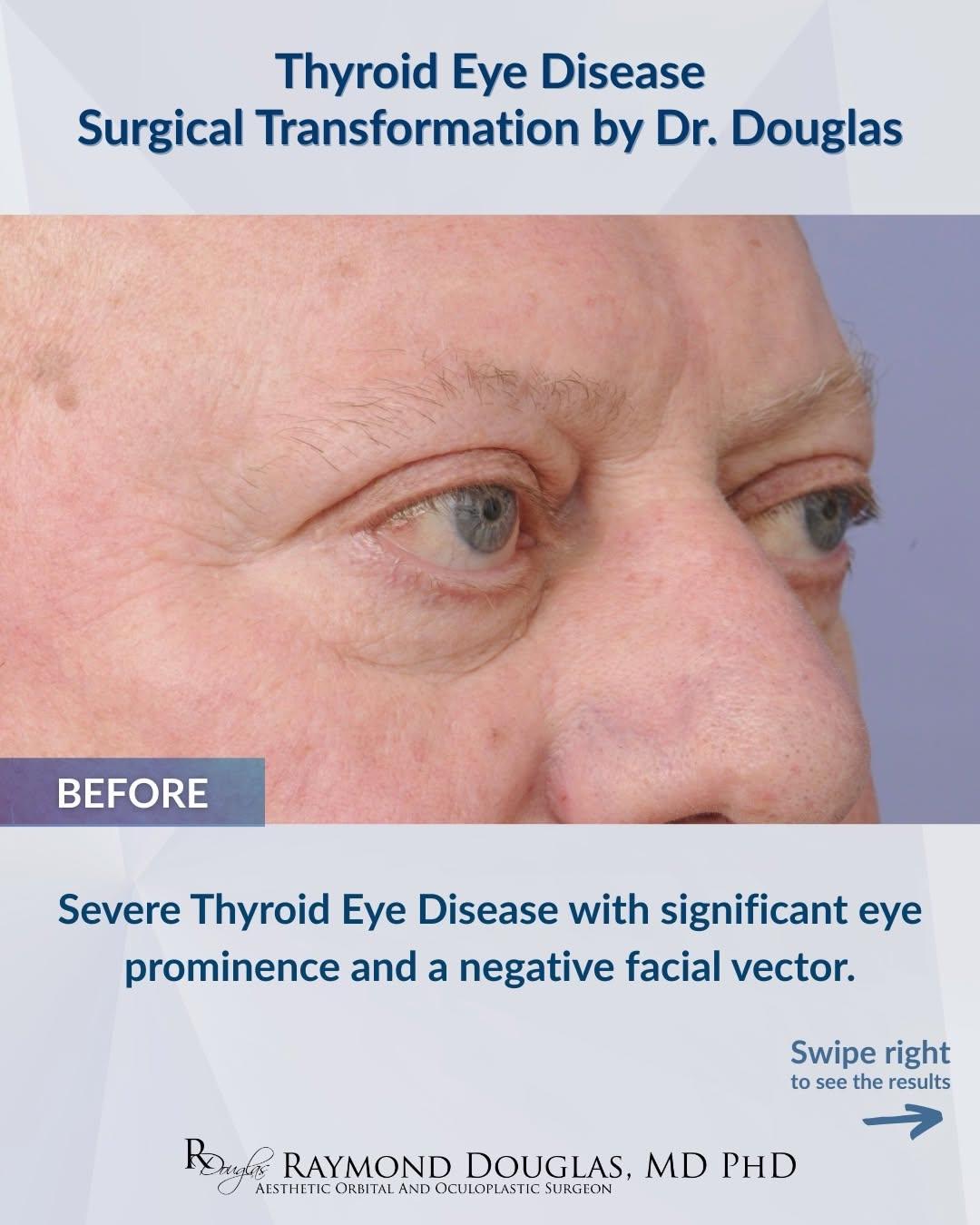 Instagram post by Dr. Raymond S. Douglas: Not every case of Thyroid Eye Disease can be treated the same way. For this patient, achieving the best outcome required a highly individual…