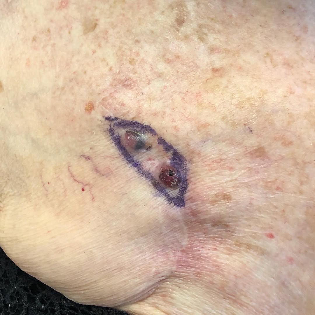 Instagram post by Dr. Razieh Soltani: May is skin cancer awareness month. Call your dermatologist if you have new/changing moles. #skincancer #dermatology #melanoma #teledermatol…