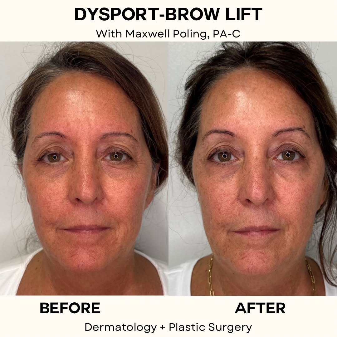 Instagram post by Dr. Rebecca Novo: In a world where there’s never enough sleep, lean on me and my trusty Dysport to help you look a little more refreshed. 👀✨ When treating th…