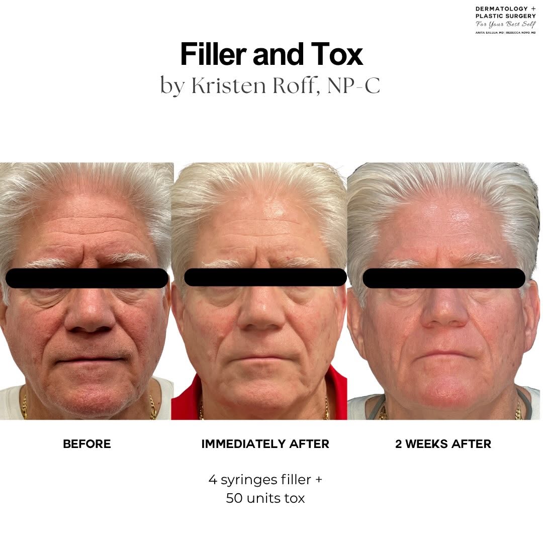 Instagram post by Dr. Rebecca Novo: REFRESHED. RESTORED. STILL HIM. A full face approach to male facial rejuvenation focused on restoring structure, softening signs of aging, a…