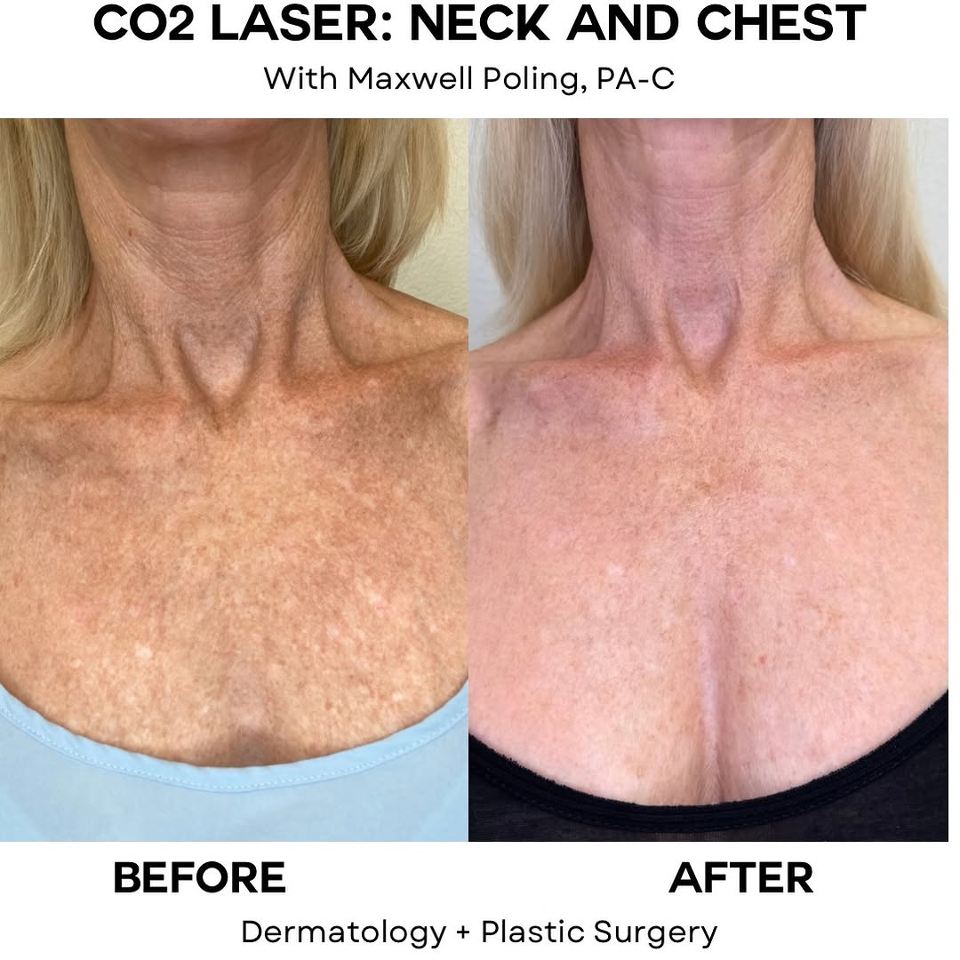 Instagram post by Dr. Rebecca Novo: Your face shouldn’t be the only area getting all the attention 👀 The neck and chest are two of the most common areas where we see the cumul…