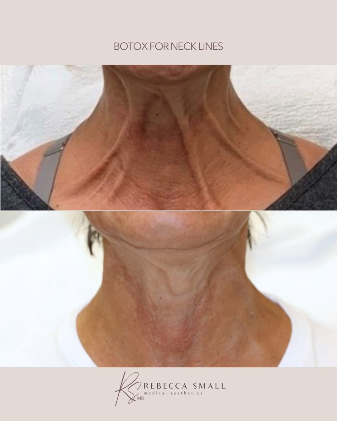 Instagram post by Dr. Rebecca Small: Want a smoother-looking neck without changing what makes you look like you? Botox®* can help soften the appearance of visible neck lines by …