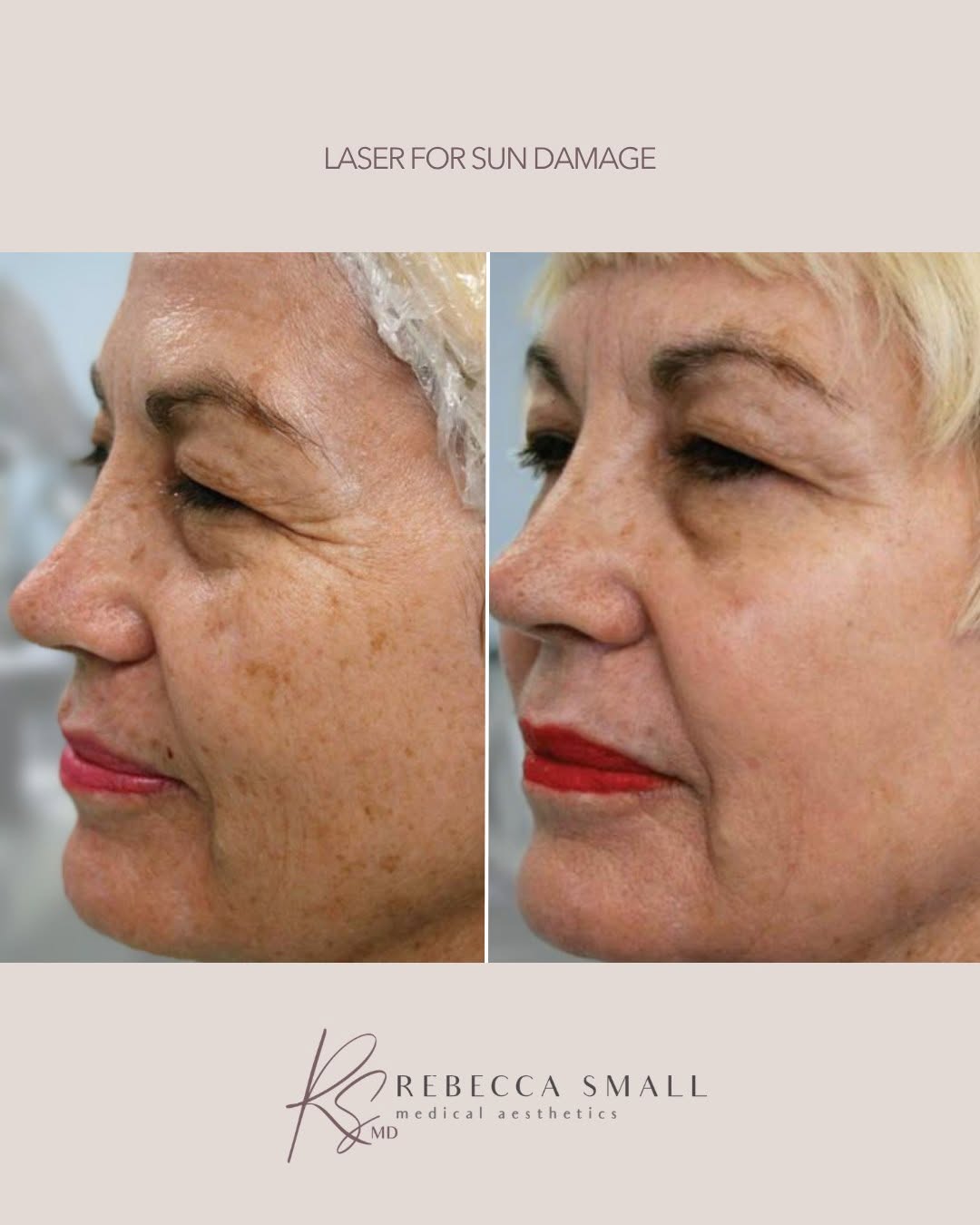 Instagram post by Dr. Rebecca Small: A little less visible sun damage. A lot more glow. Laser treatments can help improve the appearance of pigmentation, uneven tone, and other …