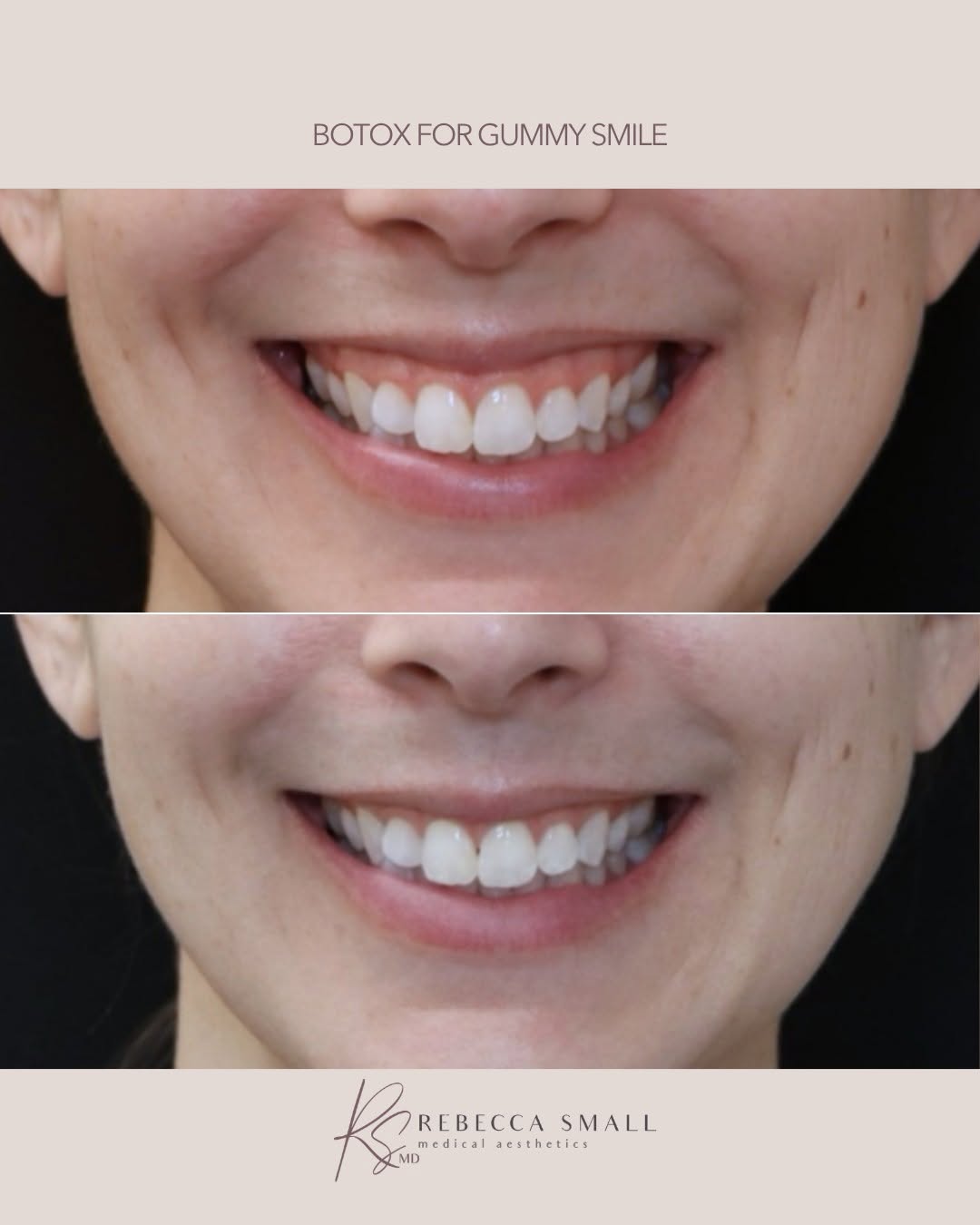 Instagram post by Dr. Rebecca Small: A subtle change can make a beautiful difference. Botox®* can help relax the targeted muscles that pull the upper lip upward, reducing the am…