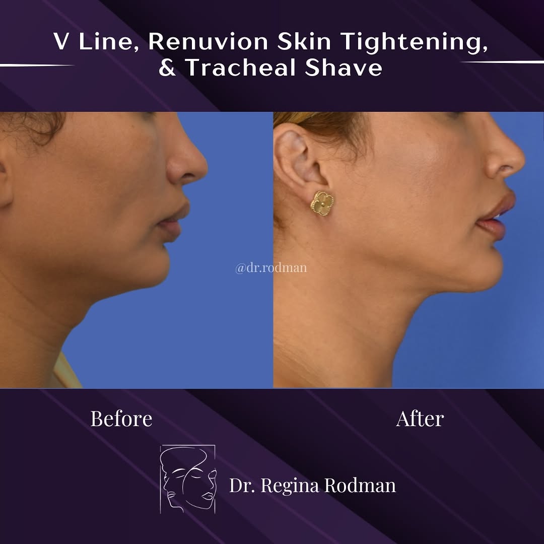 Instagram post by Dr. Regina Rodman: Lower Face Transformation: ✨Genioplasty, Vline Surgery, Renuvion Skin Tightening + Tracheal Shave | 1 Year Post-Op ✨ This patient wanted to …