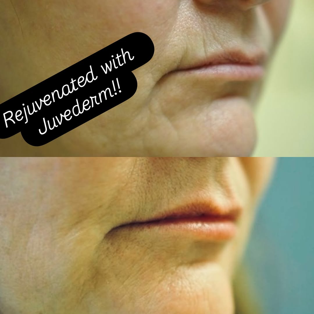 Instagram post by Dr. Renuka Diwan: ”Smokers’ lines” -the most detested of all facial wrinkles, really make patients feel unattractive. Almost always a priority over other wrin…