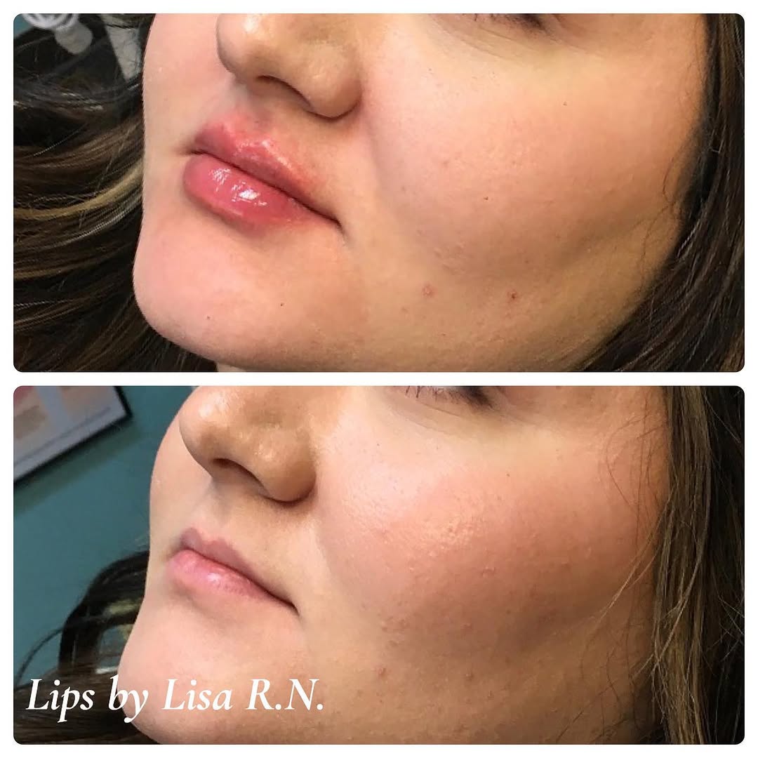 Instagram post by Dr. Rex Moulton-Barrett: First time lip filler on this beauty!! 1ml of Juvederm Ultra for a fuller lip. Lips by Lisa 💋