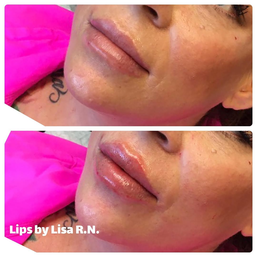 Instagram post by Dr. Rex Moulton-Barrett: Lip maintenance treatment on this gorgeous patient. 💗👄👄 Injected by Lisa Product used: 1ml Restylane Kysse 💋 #lipfiller #restylane #lips…