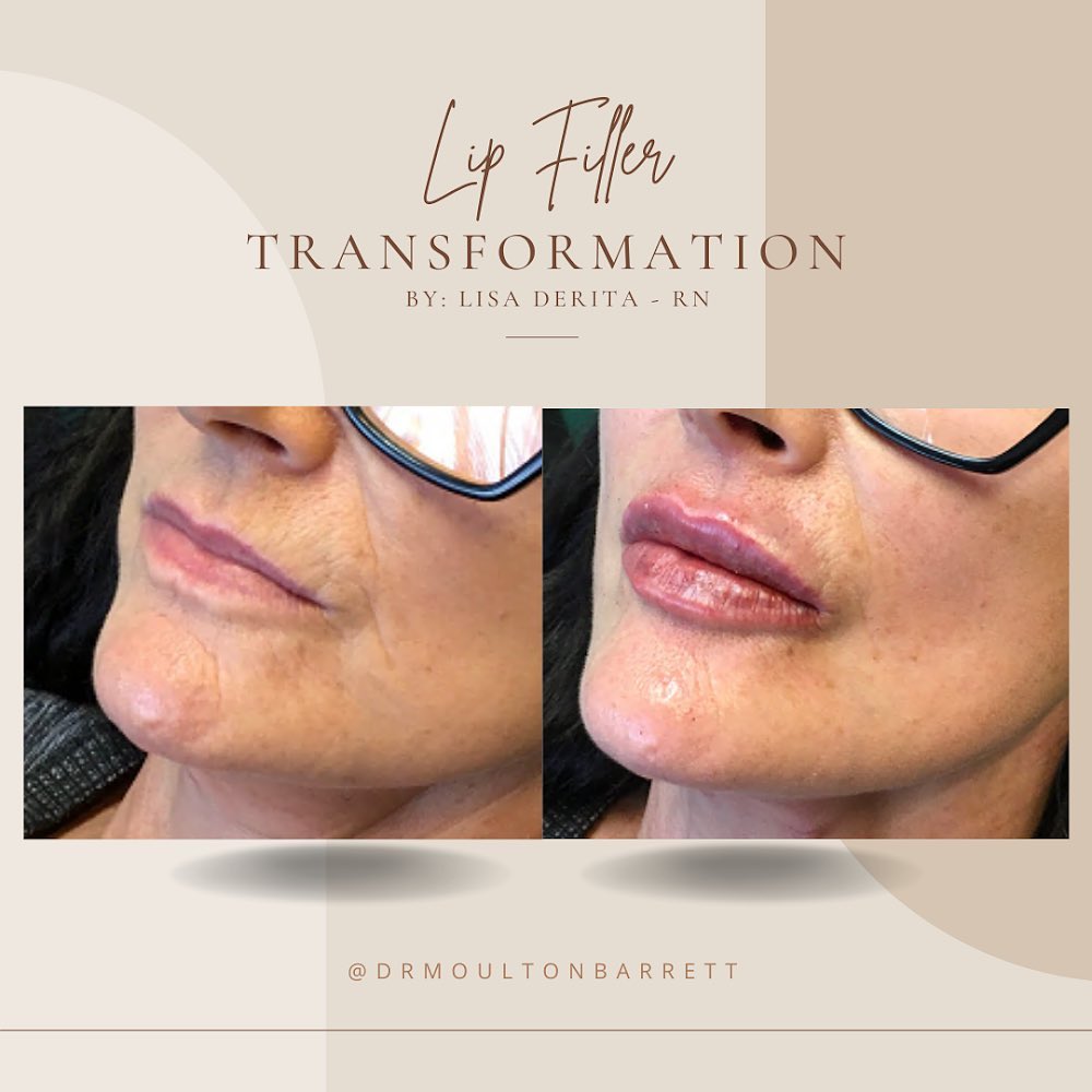 Instagram post by Dr. Rex Moulton-Barrett: Obsessed with this transformation! Added definition, more youthful look, & said goodbye to the fine lines! Lips by Lisa 👄 1ml Restylane Kys…