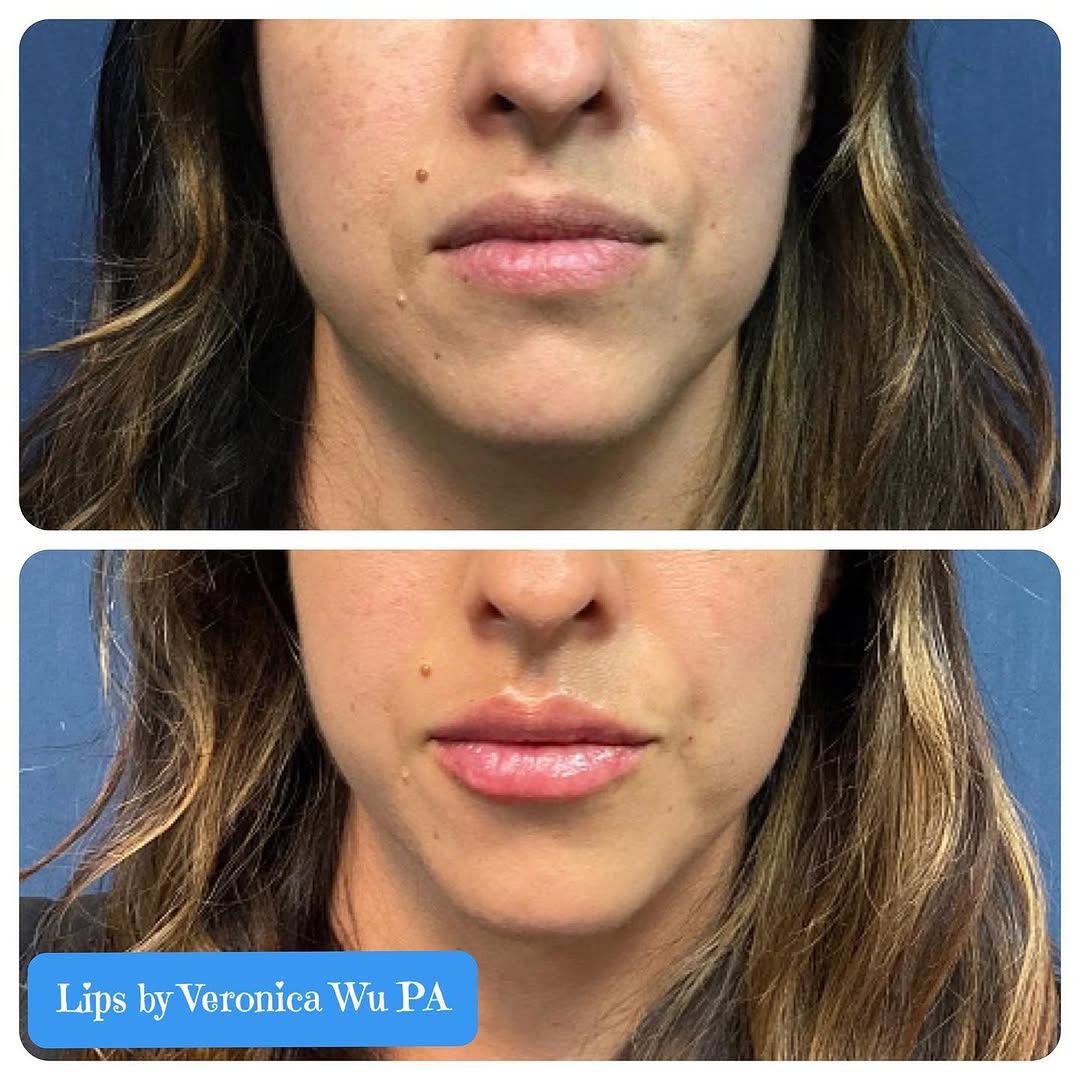 Instagram post by Dr. Rex Moulton-Barrett: Happy Friday! If you been complementing getting lip filler.. this is your sign 🫦 These lips have been rejuvenated and rehydrated with 1ml R…
