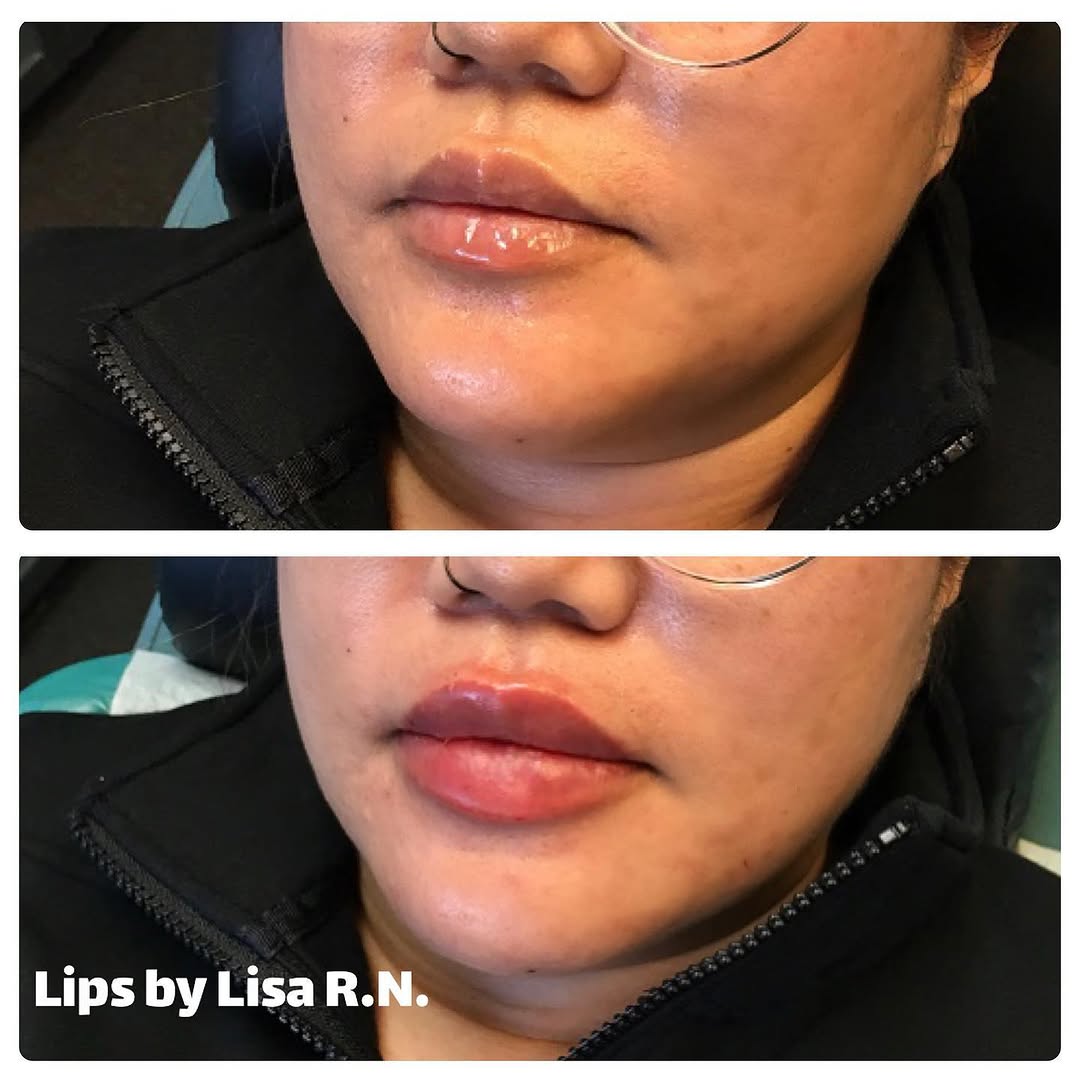 Instagram post by Dr. Rex Moulton-Barrett: Happy Monday! 😁 Here are some beautiful lips done with 1ml Restylane Kysse. Book your appointment today @ (925)240-8775 Lips by Lisa ❤️💋 #…