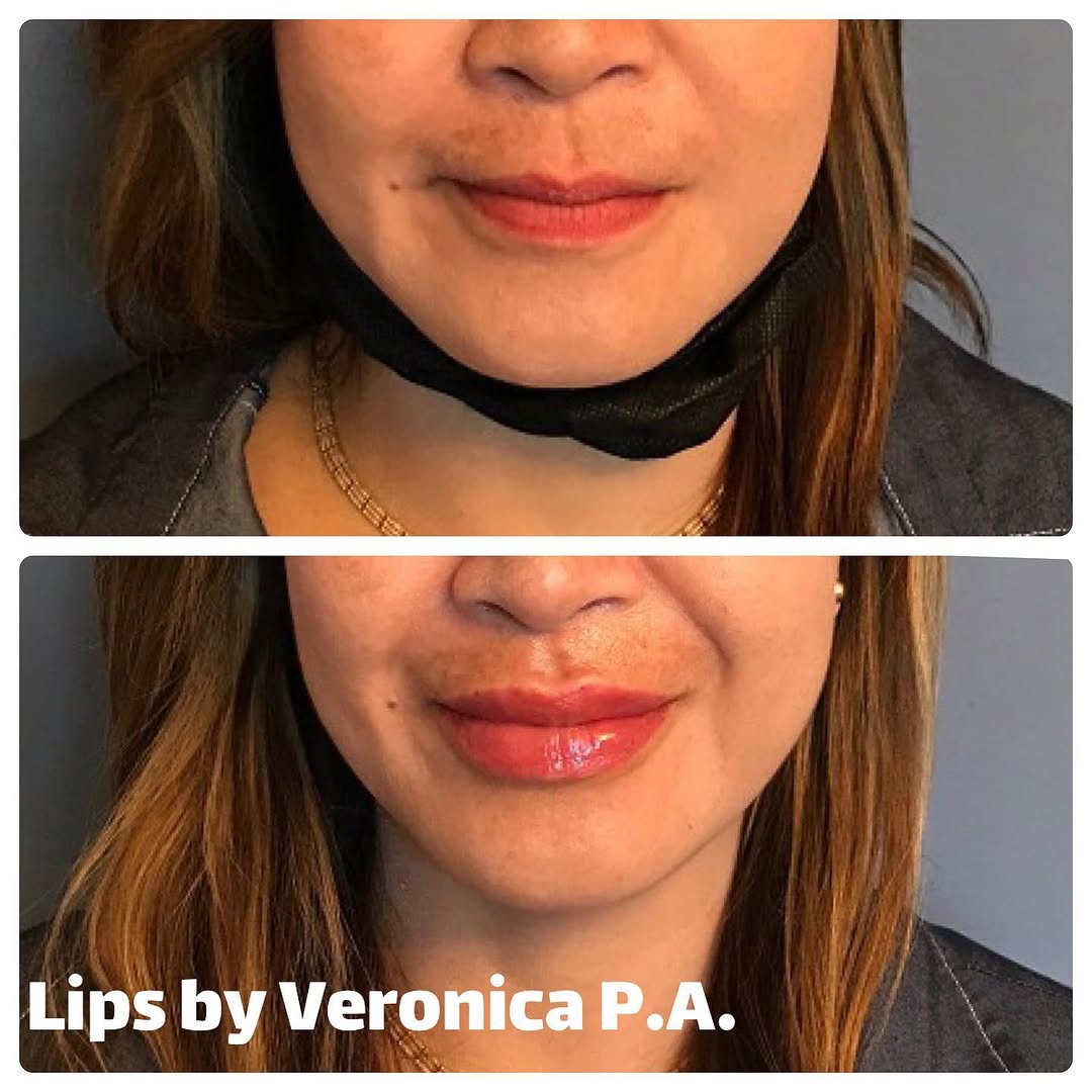 Instagram post by Dr. Rex Moulton-Barrett: Happy Friday!! Look at these gorgeous lips! 😍👄 Product: 1ml Restylane Silk Lips by Veronica #lip #lipfiller #restylane #restylanelips #lip…