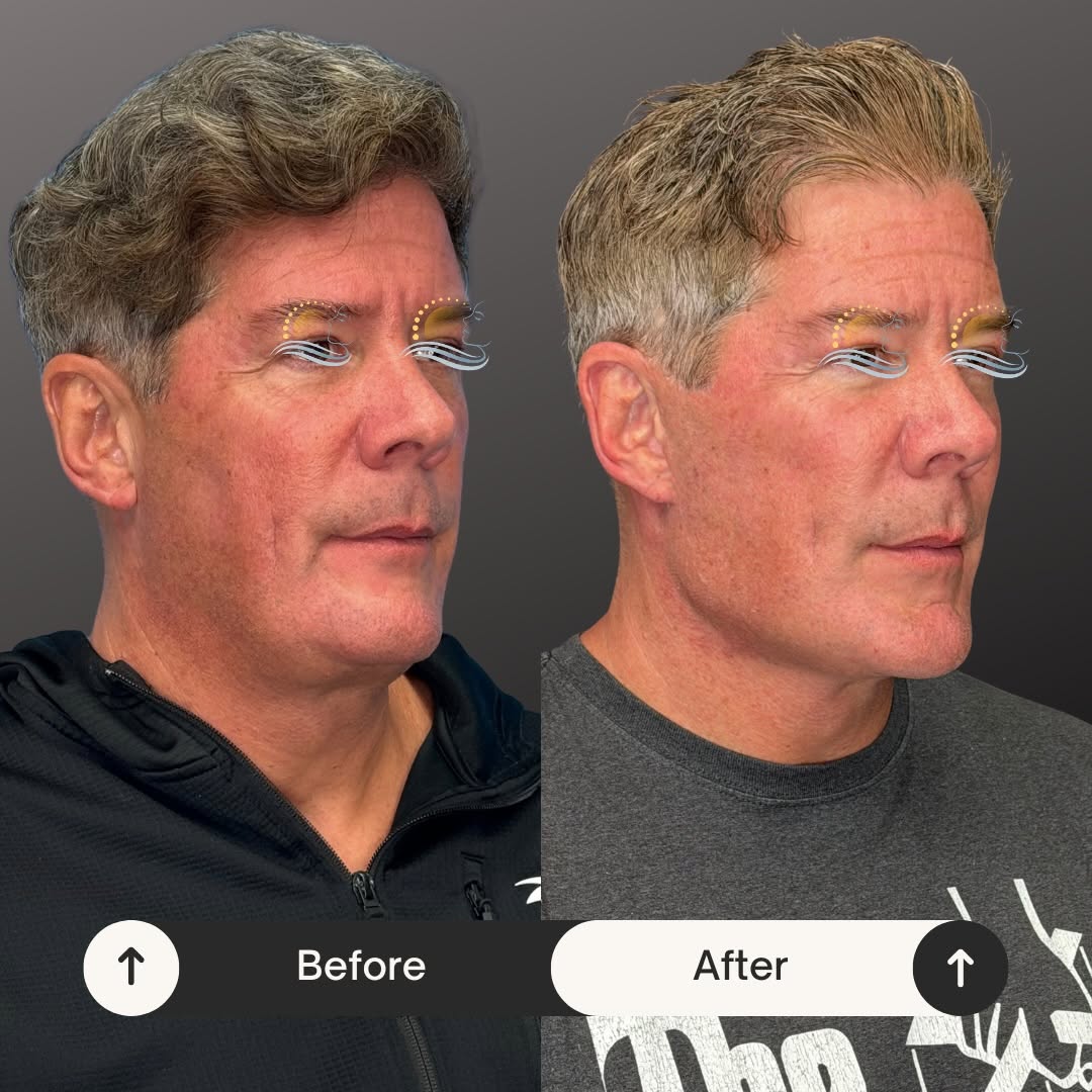 Instagram post by Dr. Reza Bolourian: Male facial surgery to correct previous issues. #facialrejuvenation #facialplasticsurgery #snatch