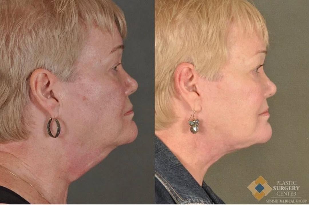 Instagram post by Dr. Reza Momeni: Natural is the name of the game!!! #Repost @plasticsurgerysmg ・・・ Check out this great #transformationTuesday of Dr. Momeni's patient that r…