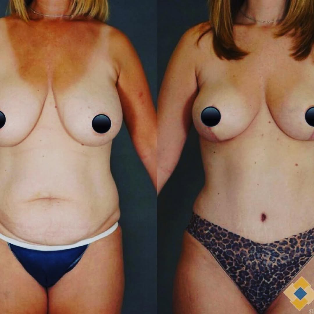 Instagram post by Dr. Reza Momeni: #Repost @plasticsurgerysmg ・・・ Check out this week's #TransformationTuesday of Dr. Reza Momeni's patient that received a mommy makeover: bre…