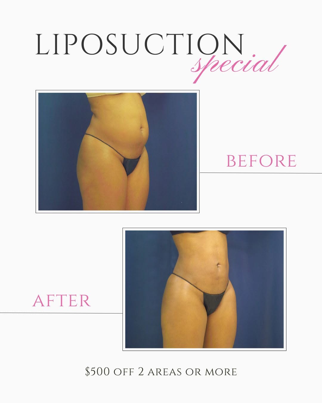 Instagram post by Dr. Ricardo L. Rodriguez: Considering liposuction to address stubborn areas that don’t respond to diet or exercise? Dr. Ricardo L. Rodriguez, MD is a board-certified …