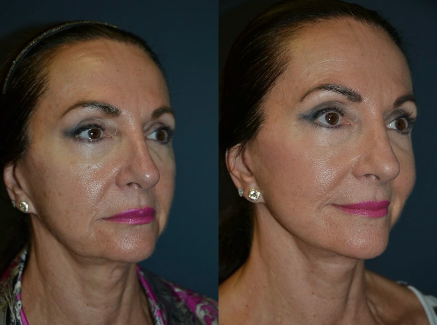 Instagram post by Dr. Richard A. Bartlett: Our recent facelift with upper blepharoplasty (eyelid) patient is absolutely thrilled with her results, and she is less than 2 months out fr…