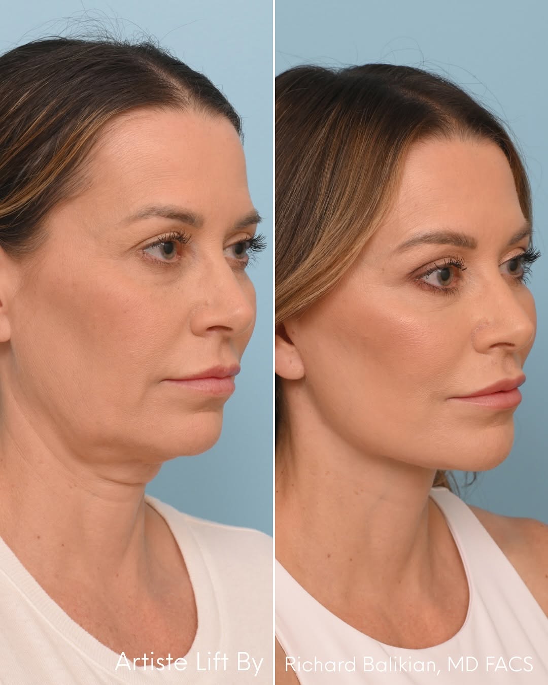 Instagram post by Dr. Richard Balikian: A perfect example of how the right procedure can turn back the clock! ⏰🌟 This beautiful patient came in looking for a refreshed and natural…