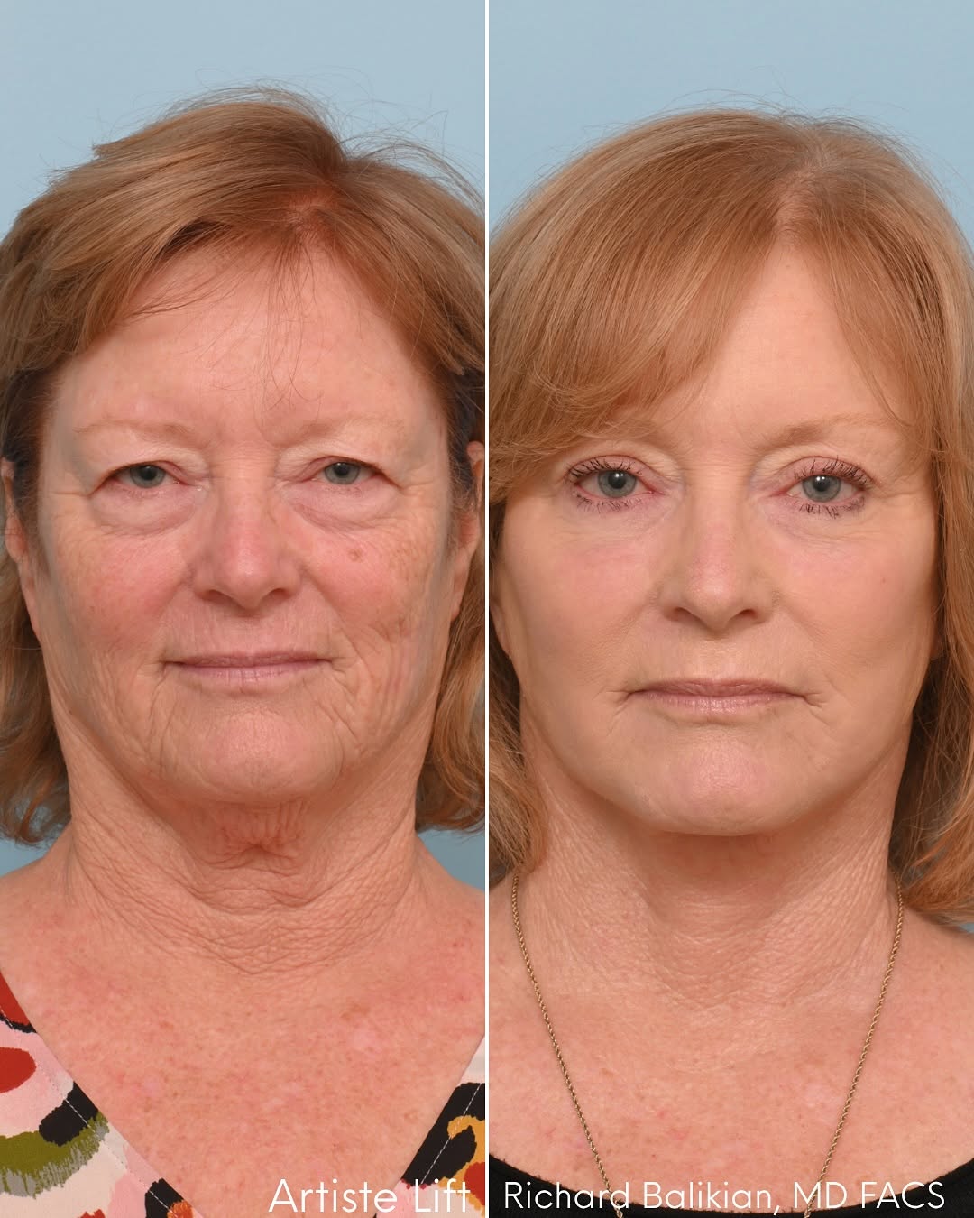 Side-by-side before and after photos of a female patient who underwent Dr. Richard Balikian’s signature Artiste Lift, showing smoother skin, lifted jawline, rejuvenated neck, and brighter eyes with na