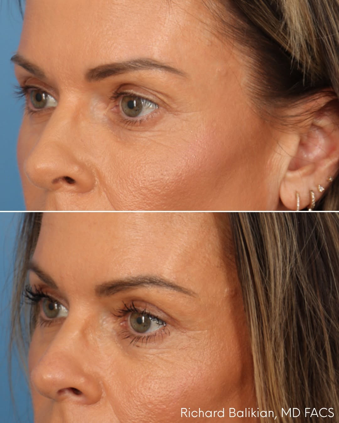 Upper blepharoplasty result demonstrating reduced excess upper eyelid skin and a more open, energized appearance without an overdone or hollow look.