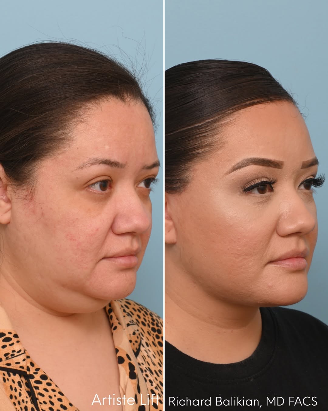 Side-profile before-and-after of a woman in her early 40s following an Artiste Lift™, showing improved jawline definition, neck contour, and facial rejuvenation.