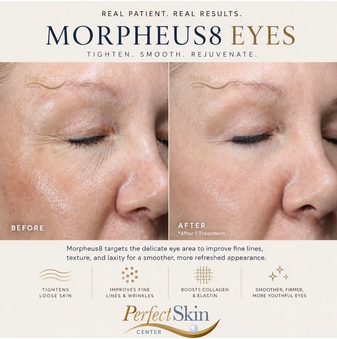 Instagram post by Dr. Richard Burgmeier: This patient was treated with Morpheus8 Eyes, a radiofrequency microneedling treatment designed to improve the delicate skin around the eyes…