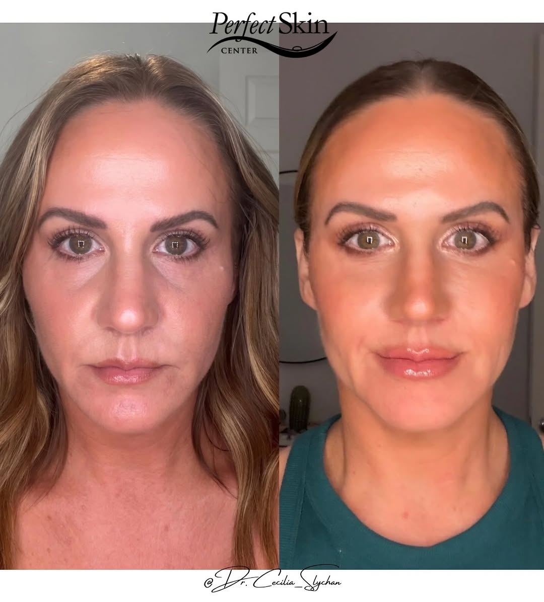 Instagram post by Dr. Richard Burgmeier: Can you guess what she did? Most people can’t.🤭She simply looks more refreshed, rested, and balanced Treatment: ✨ 1 syringe of Defyne per t…