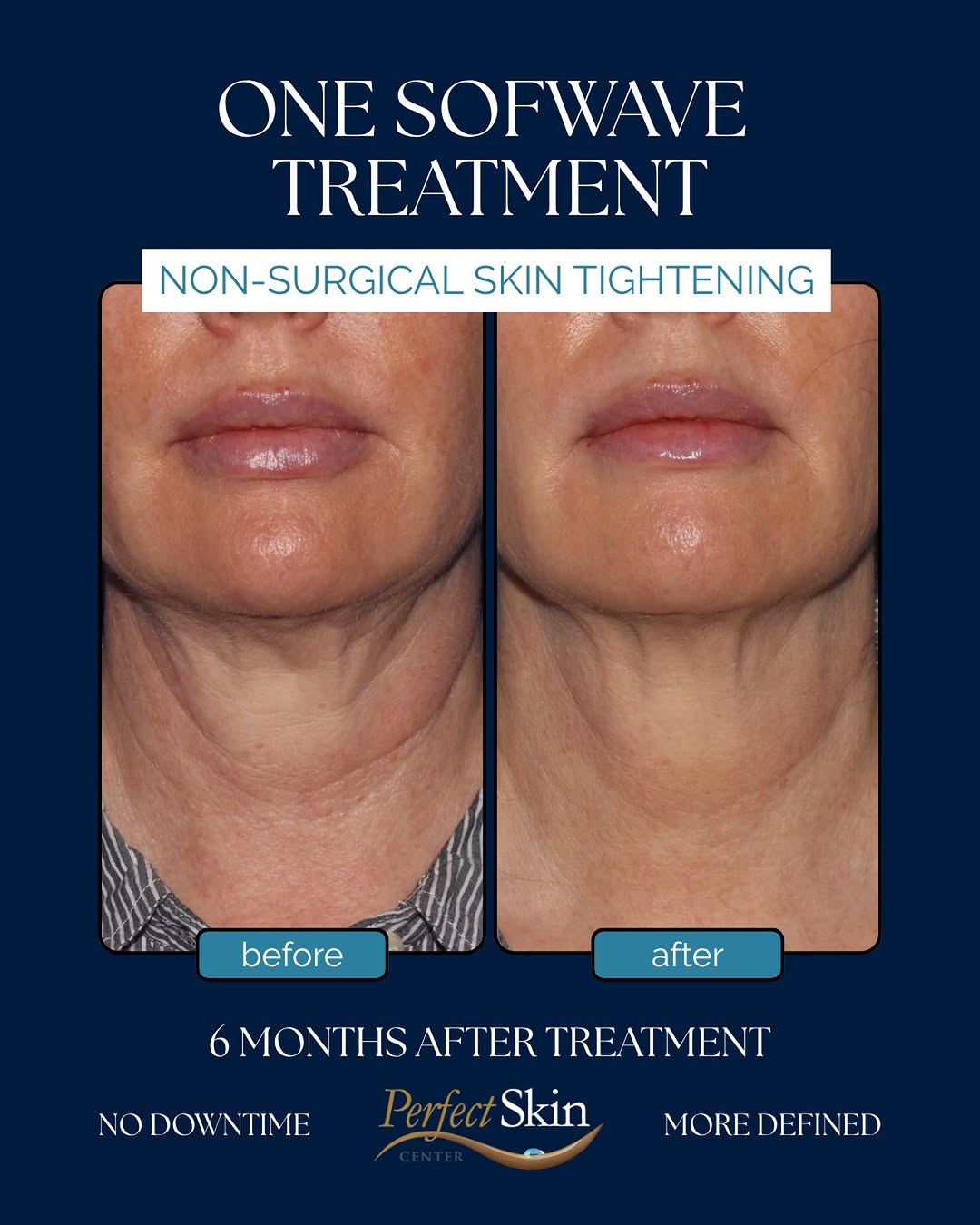 Instagram post by Dr. Richard Burgmeier: ONE TREATMENT. A FIRMER-LOOKING NECK. Sofwave uses advanced ultrasound technology to stimulate your body’s natural collagen production, help…