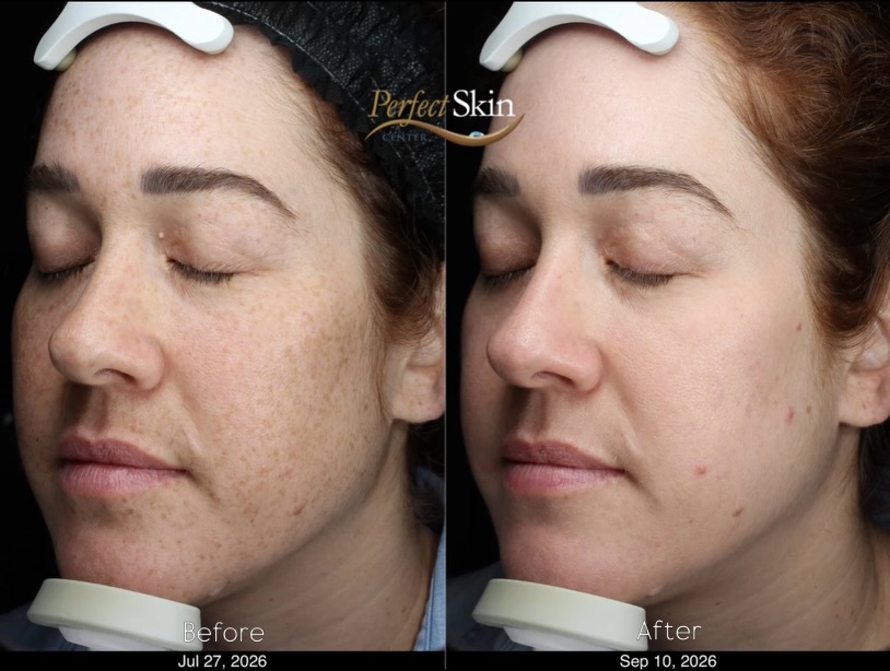 Instagram post by Dr. Richard Burgmeier: BBL + HALO 💥 Sciton Combination Laser Resurfacing Pre-treatment: ALASTIN Restorative Skin Complex Post-treatment: VIVE Exosomes🧬 ONE TREAT…