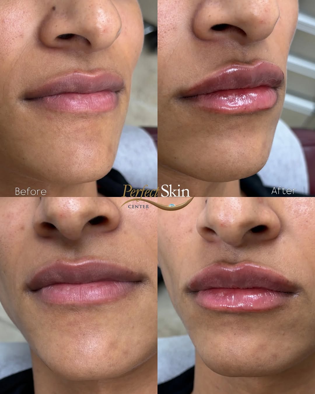 Instagram post by Dr. Richard Burgmeier: Building beautiful lips gradually🌟 This patient began her lip filler journey with 1.0 mL on August 3, followed by an additional 0.7 mL on A…