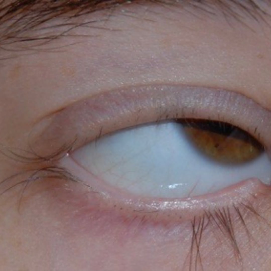 Instagram post by Dr. Richard C. Allen: Trichotillomania #oculoplastics #oculoplasticsurgery #oculoplasticsurgeon #trichotillomania