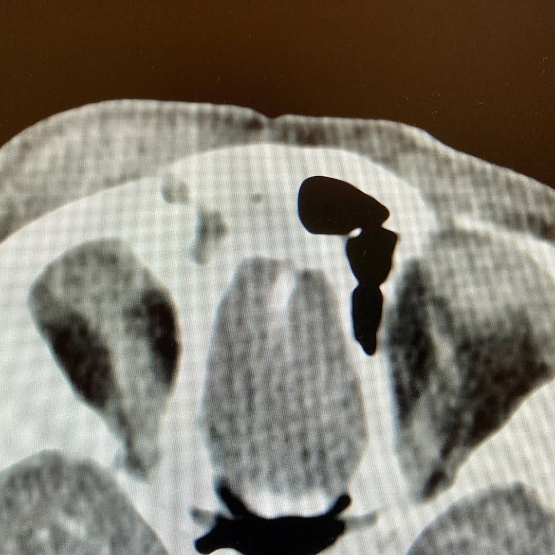 Instagram post by Dr. Richard C. Allen: Pott's puffy tumor #oculoplastics #oculoplasticsurgery #oculoplasticsurgeon #pottspuffytumor