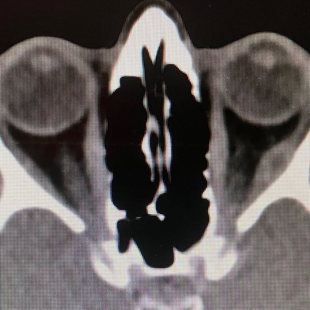Instagram post by Dr. Richard C. Allen: Orbital myositis associated with Crohn's disease #chronsdisease #orbitalmyositis #oculoplastics #oculoplasticsurgery #oculoplasticsurgeon #o…
