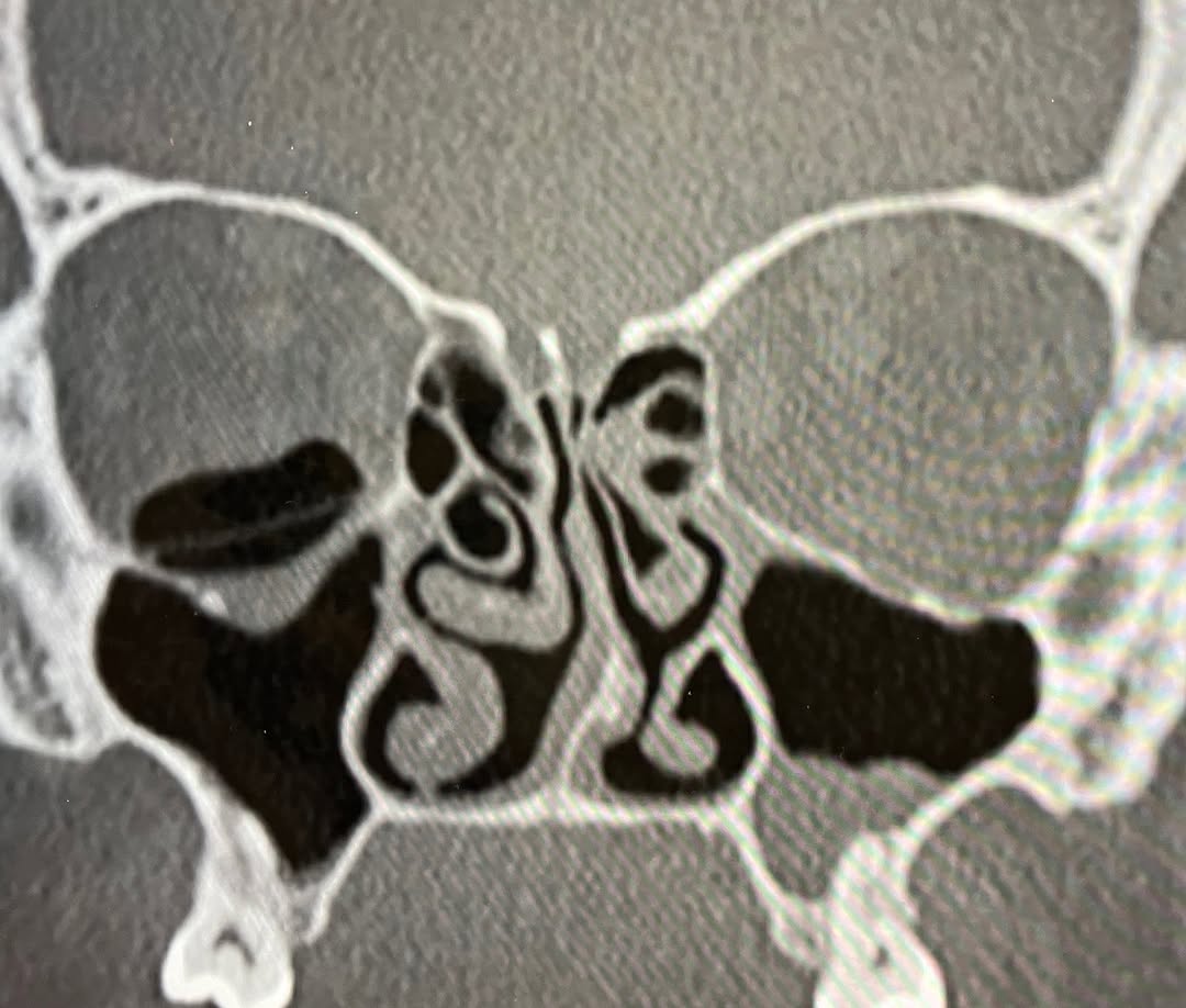 Instagram post by Dr. Richard C. Allen: Emphysema around an orbital floor implant #floorfracture #orbitalemphysema #orbitalimplants #oculoplastics #oculoplasticsurgery #oculoplasti…
