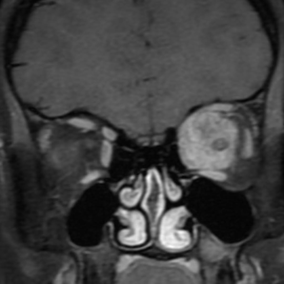 Instagram post by Dr. Richard C. Allen: Optic nerve sheath meningioma #opticnervemeningioma #meningioma #opticnervesheathmeningioma #oculoplastics #oculoplasticsurgery #oculoplasti…