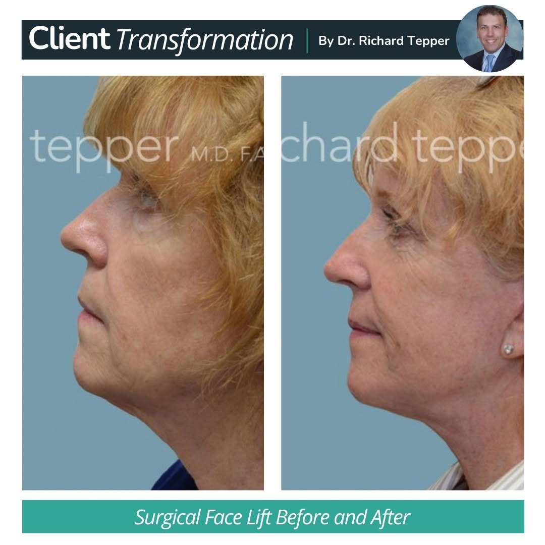 Instagram post by Dr. Richard E. Tepper: Check out these stunning results post-surgery! This patient was in her 50s when she came to Dr. Tepper to feel younger and more confident. D…