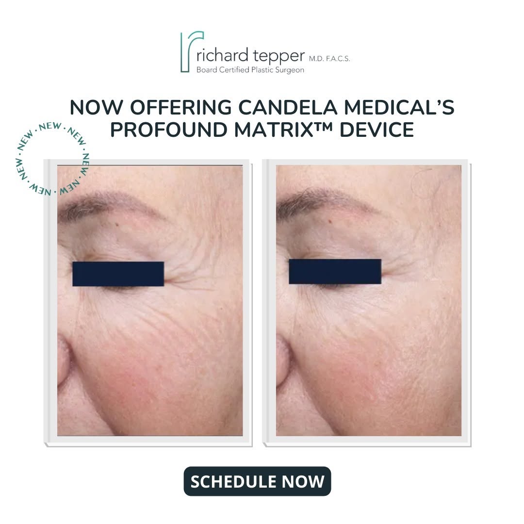 Instagram post by Dr. Richard E. Tepper: Exciting update! Dr. Tepper is now offering the Profound Matrix™ Laser, a one-stop solution for skin tightening. This non-invasive treatment…