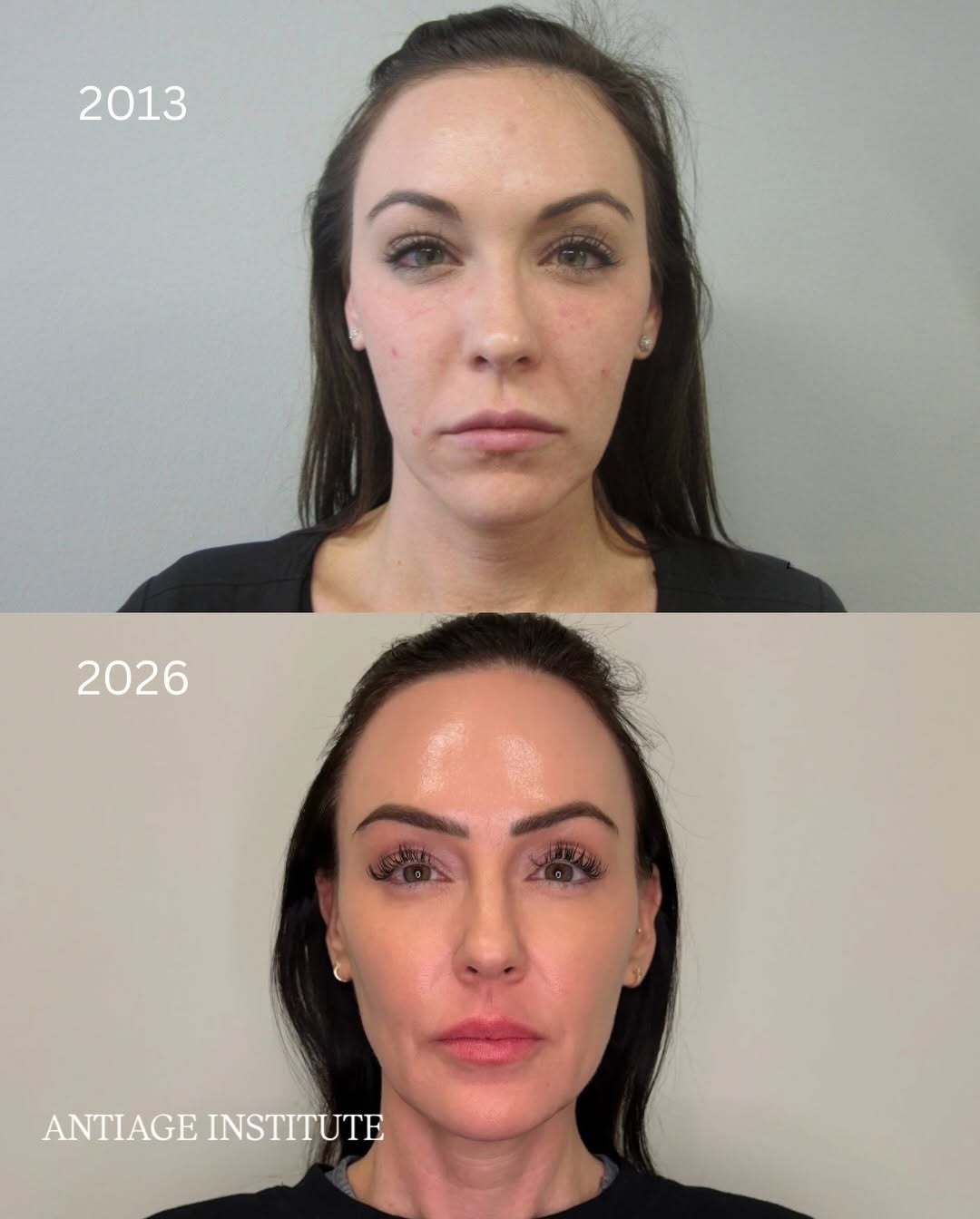 Instagram post by Dr. Richard H. LeConey: ✨ Nataleigh’s 13-year transformation ✨ Nataleigh’s before-and-after isn’t about one treatment, it’s the result of 13 years of consistency an…